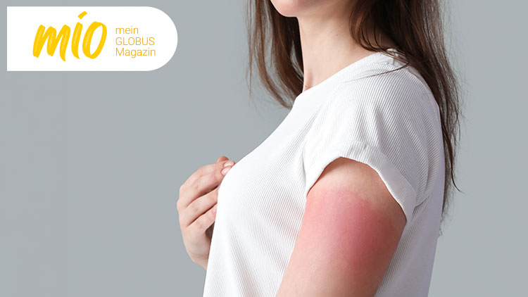 Vor grauem Hintergrund hält eine Person in weißem Shirt ihren Oberarm mit sonnenverbrannter Haut, oben links mio mein GLOBUS Magazin.