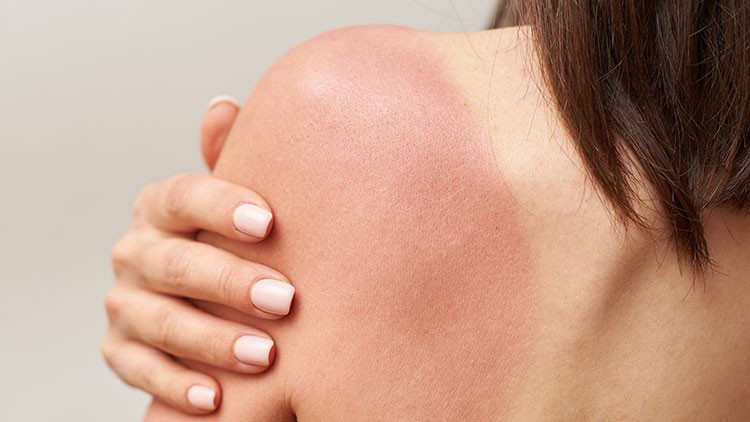 Ein nackter Rücken mit Sonnenbrand auf der Schulter, eine Hand mit lackierten Nägeln berührt die Haut.