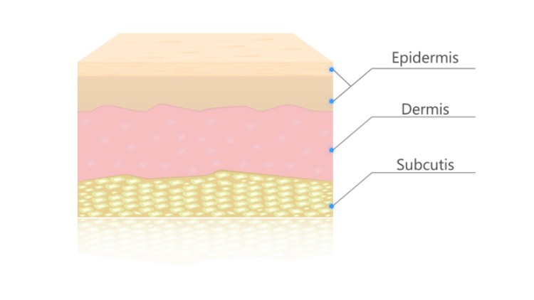 Schematische Darstellung eines Hautschnitts mit drei Schichten, beschriftet als Epidermis, Dermis und Subcutis.