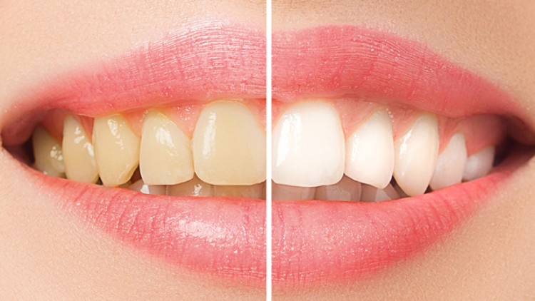 Nahaufnahme eines Mundes mit zweigeteiltem Bild, links gelbliche Zähne, rechts weiße Zähne, Lippen in rosa Farbton.